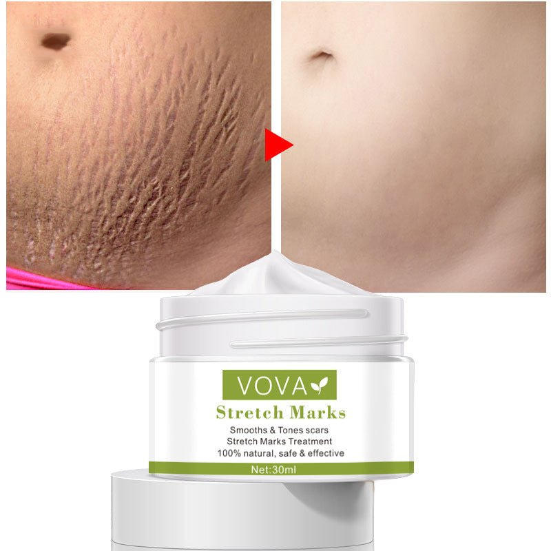 Anti - Stretch Marks Scar Removal Cream - LUNA