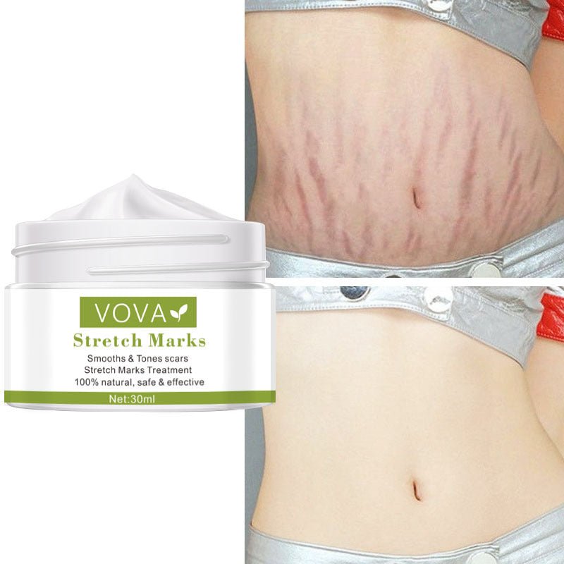 Anti - Stretch Marks Scar Removal Cream - LUNA