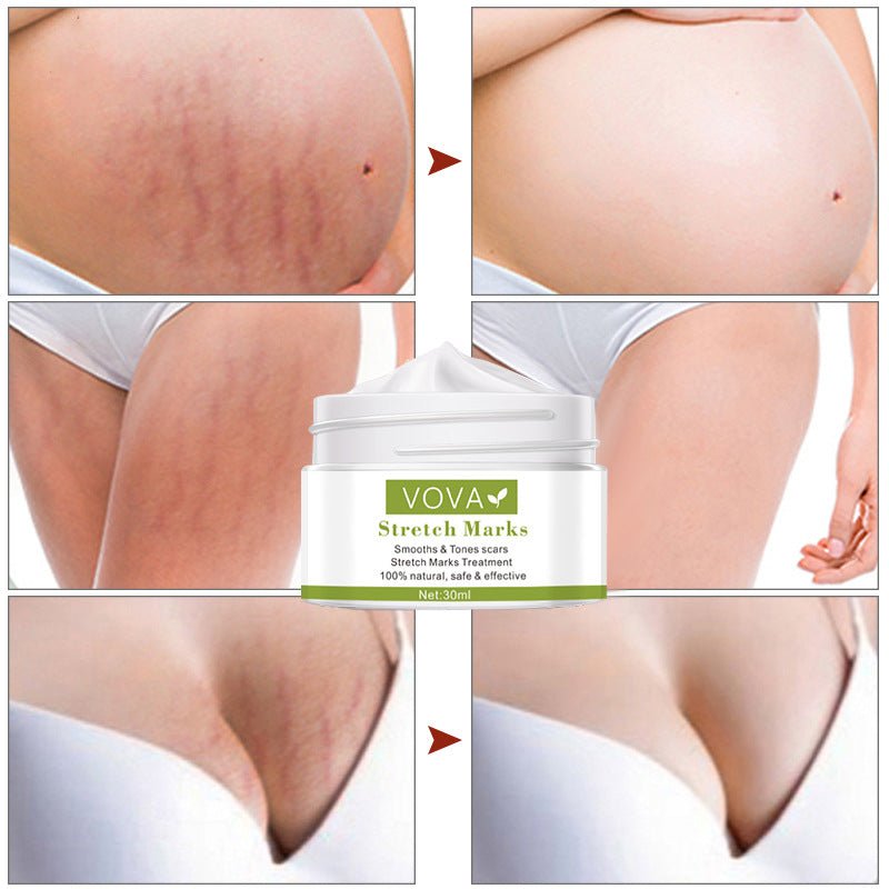Anti - Stretch Marks Scar Removal Cream - LUNA