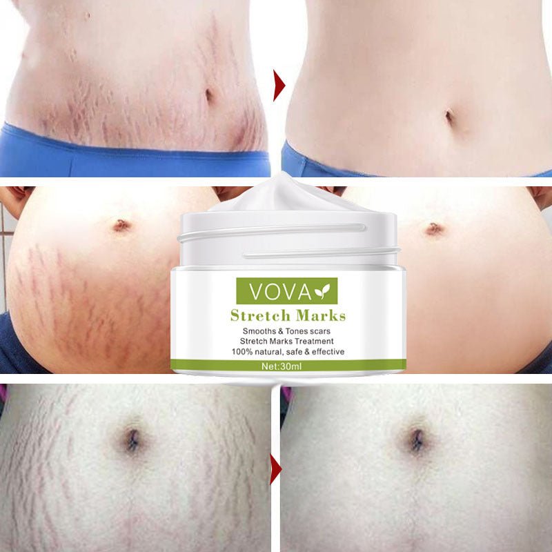 Anti - Stretch Marks Scar Removal Cream - LUNA