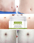 Anti - Stretch Marks Scar Removal Cream - LUNA